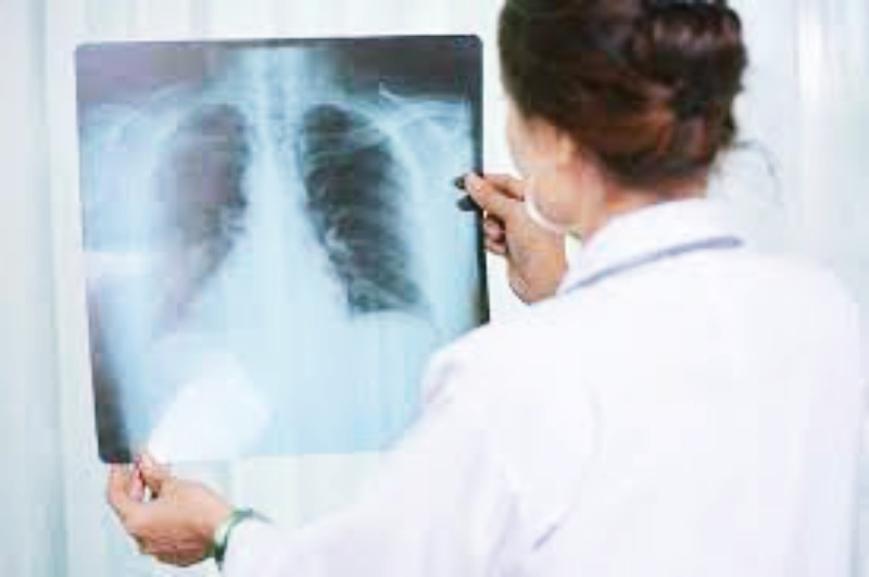 LA SS FEDERAL HA DETALLADO UN INCREMENTO DE TUBERCULOSIS RESPIRATORIA EN LAS PRIMERAS SEMANAS DE 2026