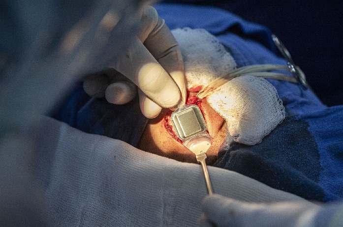 IMPLANTE COCLEAR EN UMAE HOSPITAL DE PEDIATRÍA SXXI DEL IMSS DEVUELVE PERCEPCIÓN SONORA A NIÑO CON HIPOACUSIA PROFUNDA BILATERAL