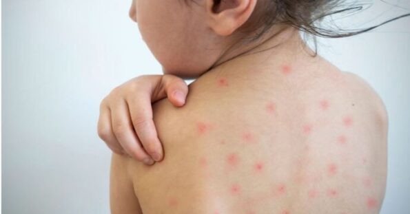 EL SARAMPIÓN YA SE EXTENDIÓ POR TODO MÉXICO, LUEGO DE QUE PUEBLA CONFIRMARA UN PRIMER CASO.