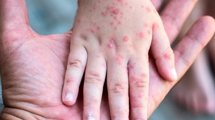 ENFERMEDADES AUTOINMUNES PODRÍAN AUMENTAR RIESGO DE CÁNCER.