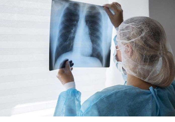 VAN 400 CASOS DE TUBERCULOSIS Y 50 MUERTES EN CHIHUAHUA ESTE AÑO